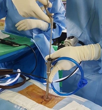Surgeons performing a medical procedure using minimally invasive surgical instruments on a patient's abdomen.