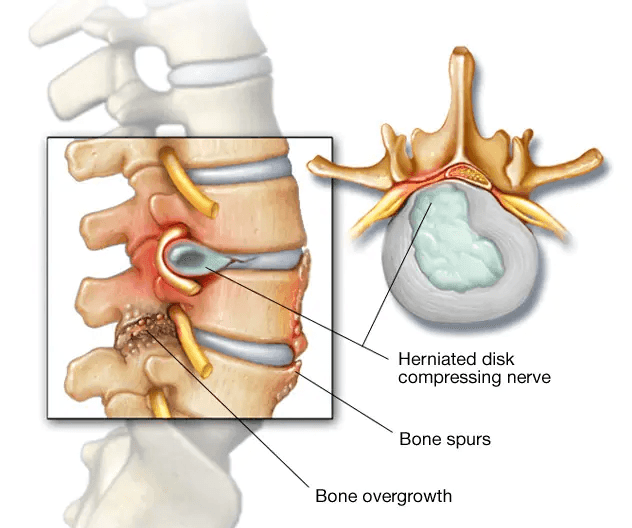 Spinal Stenosis