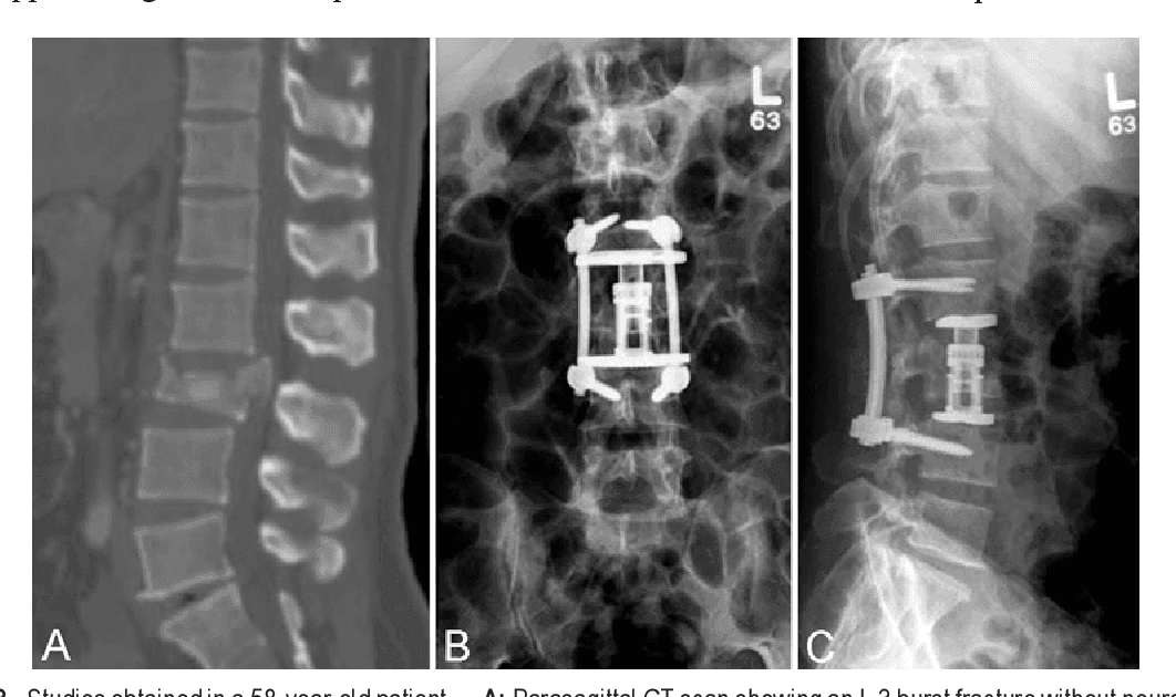 Three medical images of the spine showing a fracture and surgical implants for stabilization in different views.